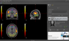 BrainMagix SPM Viewer: fMRI blobs fused with Brodmann atlas 