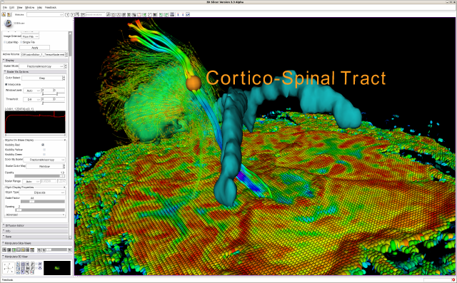 Exploring DTI visualization for neurosurgical planning