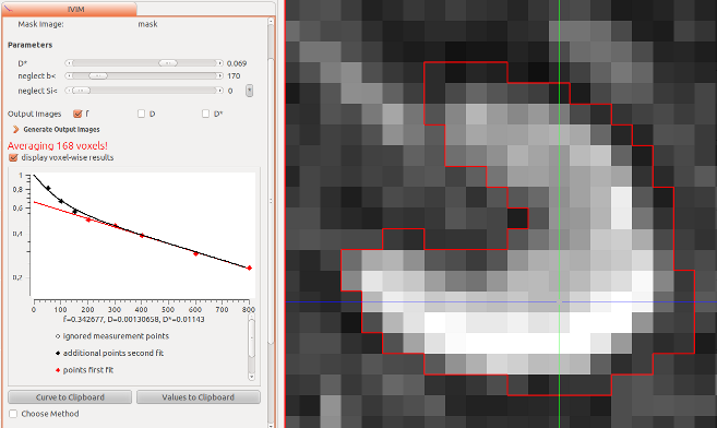 2D Region of interest and IVIM analysis