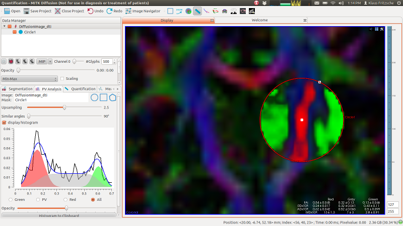 2D region of interest and PV analysis