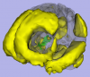 Functional Network 2, corpus callosum, hippocampus