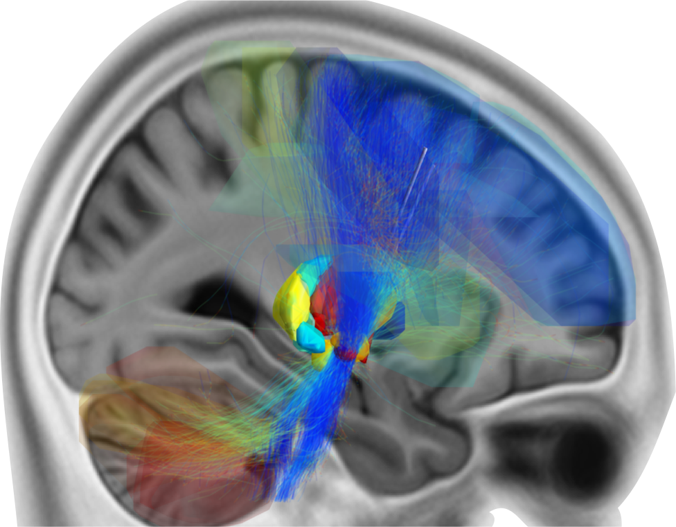 Fiber tracking to regions of the brain connected to the VAT